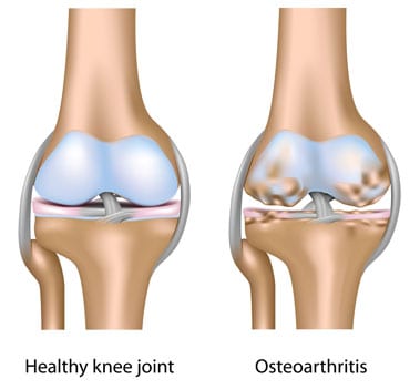 Skeleton image showing arthritis