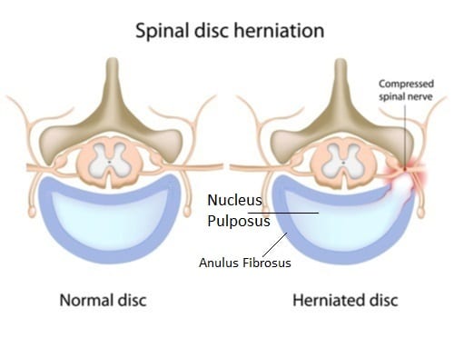 An image depicting the anatomy of a disc