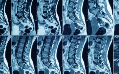 Should I Get an MRI or X-Ray Before Starting Physical Therapy?