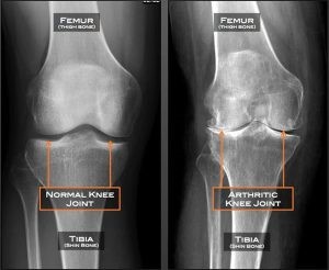 An x-ray image of a normal knee joint next to an x-ray image of a knee joint with arthritis.